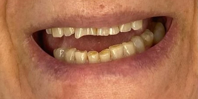 pat35-before