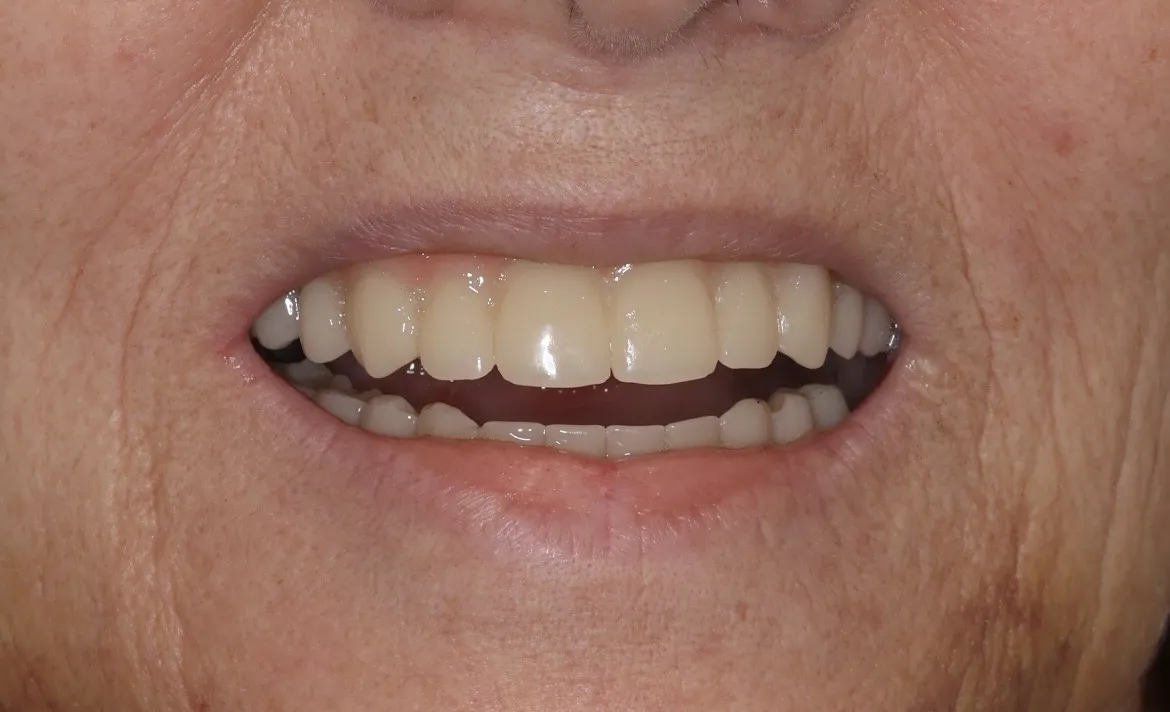 ref4-after