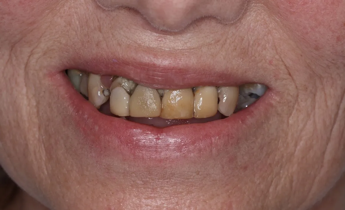 ref4-before
