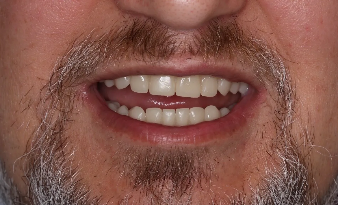 ref5-after