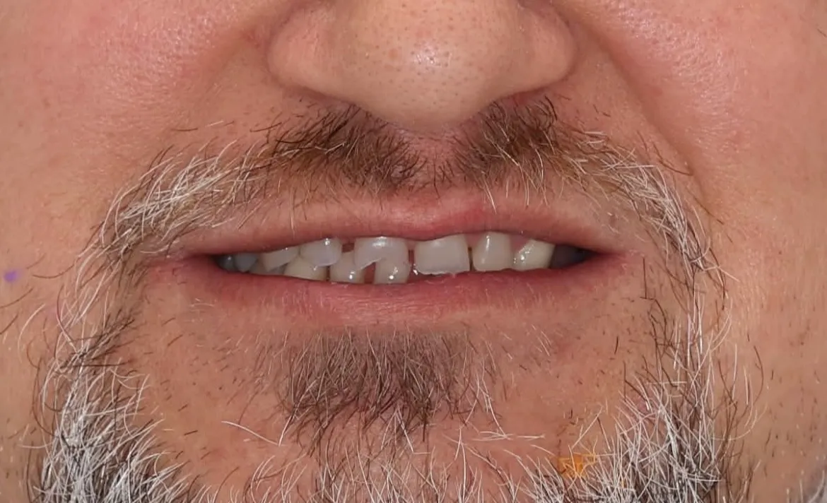 ref5-before