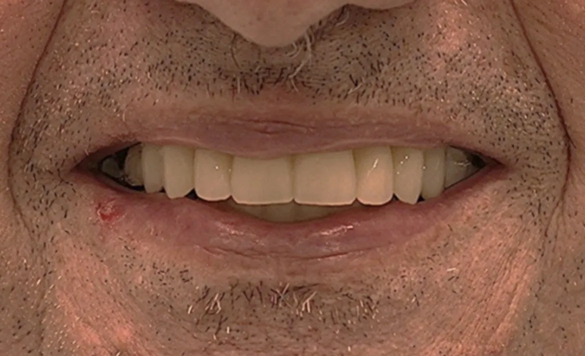 ref6-after