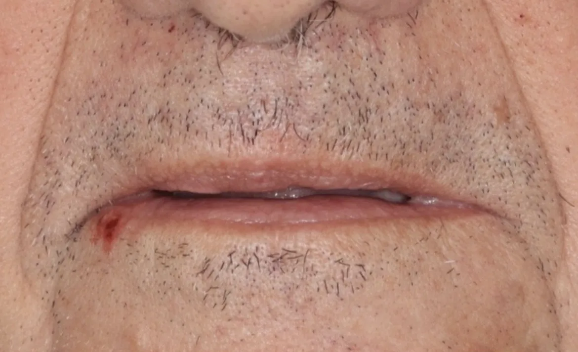 ref6-before